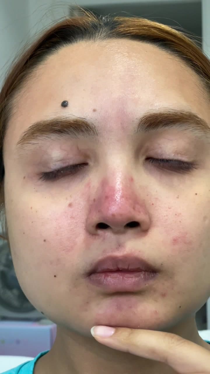 Happy Skin Transformation Reveal
